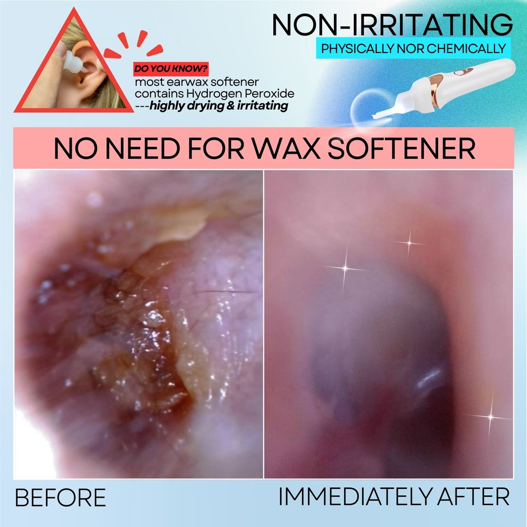 Hot Sale Earwax Vacuum Safe Painless Ear Cleaning for the Whole Family - Image 6